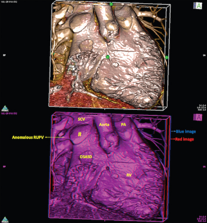 Virtual dissection (upper panel) and stereo virtual dissection image (lower panel) from a patient with sinus venous defect (#) and a small ostium secundum atrial septal defect. The lower panel when viewed using red-blue anaglyph image, on screen or in print version, provides enhanced 3D visualization of intracardiac anatomy with in-built depth perception. PA, pulmonary artery; RV, right ventricle; SCV, superior caval vein; RUPV, right upper pulmonary vein.